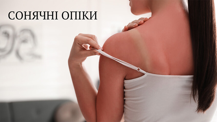 Сонячні опіки